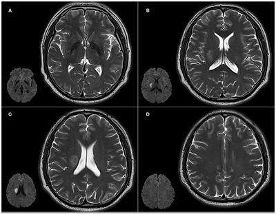 Severity of Lesions Involving the Cortical Cholinergic Pathways May Be Associated With Cognitive Impairment in Subacute Ischemic Stroke